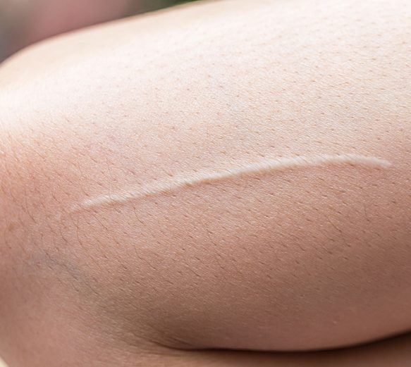Hypertrophic Scars Hypertrophic Scars