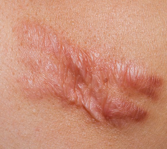 Keloid Scar Keloid Scar