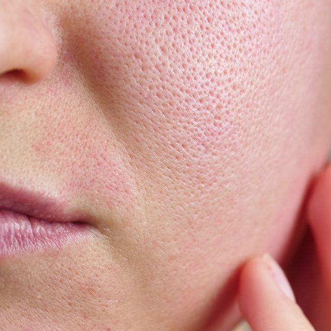 Skin Concerns - Enlarged Pores Skin Concerns - Enlarged Pores