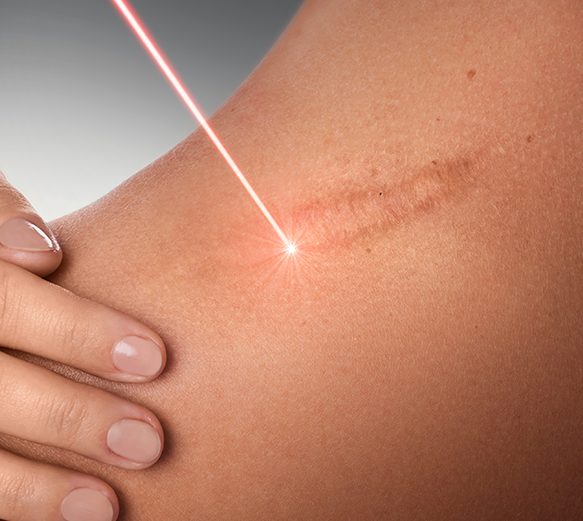 Treatments for Scarring Laser Skin Aesthetics Treatments for Scarring Laser Skin Aesthetics