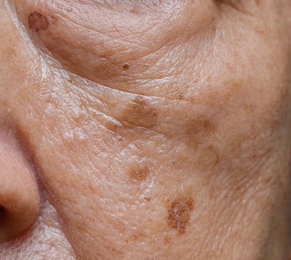 Age & Dark Spot Removal Laser Skin Aesthetics Age & Dark Spot Removal Laser Skin Aesthetics