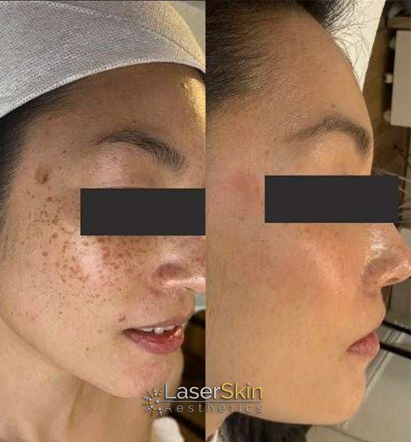 Before and After PICO Laser Treatments 2 Before and After PICO Laser Treatments 2