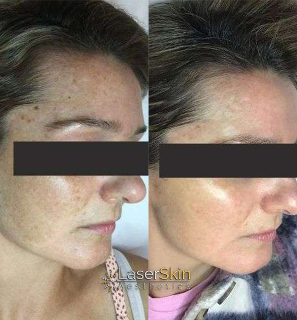 Before and After PICO Laser Treatments 3 Before and After PICO Laser Treatments 2