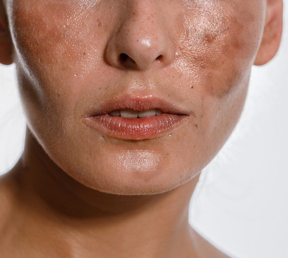 Melesma & Chloasma Laser Skin Treatment Melesma & Chloasma Laser Skin Treatment