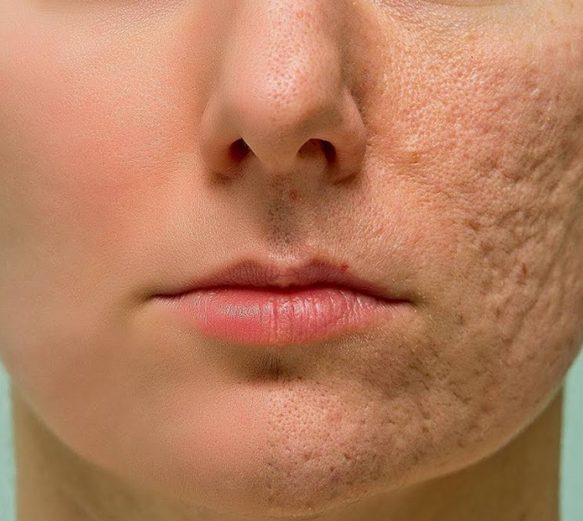Rough Skin Smoothing Laser Skin Aesthetics Rough Skin Smoothing Laser Skin Aesthetics