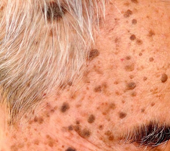 Seborrhiec Keratosis PICO treatment Laser Skin Aesthetics Seborrhiec Keratosis PICO treatment Laser Skin Aesthetics
