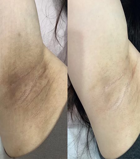 Skin Whitening Pigmentation Removal Page