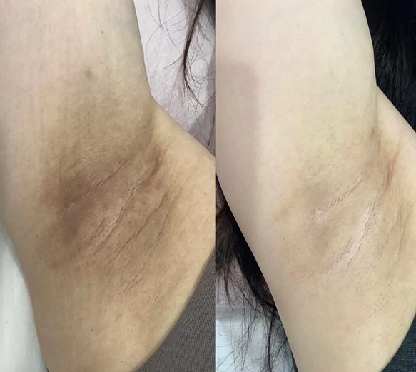 Skin Whitening Laser Skin Aesthetics