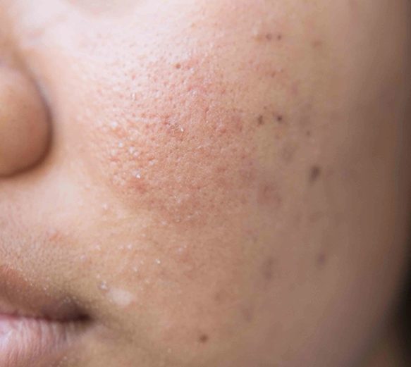 Uneven Complextion Uneven Complextion Laser Skin Aesthetics