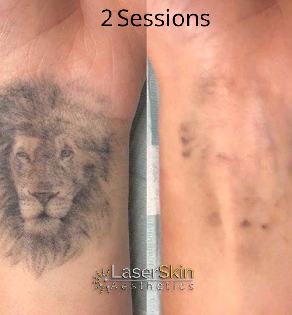 B&A Tattoo Removal FINAL 1 LSA B&A Tattoo Removal FINAL 1 LSA