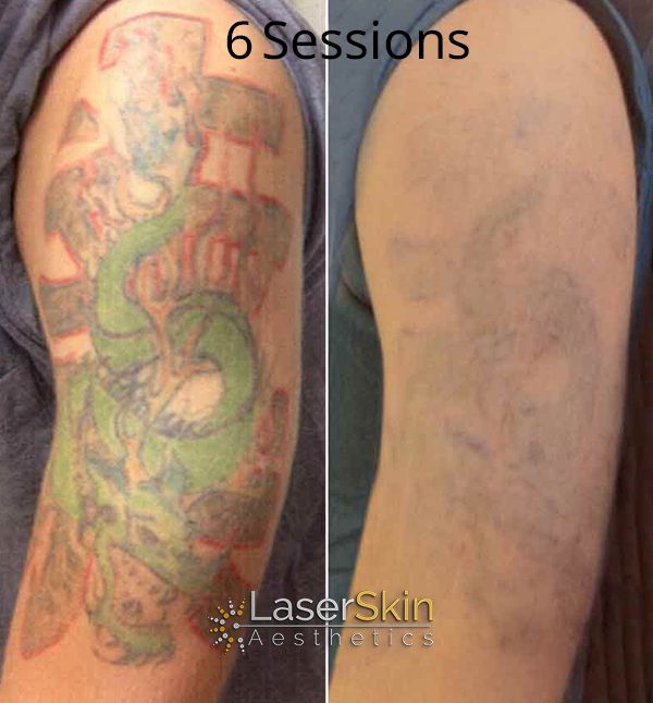 B&A Tattoo Removal FINAL 2 LSA B&A Tattoo Removal FINAL 2 LSA
