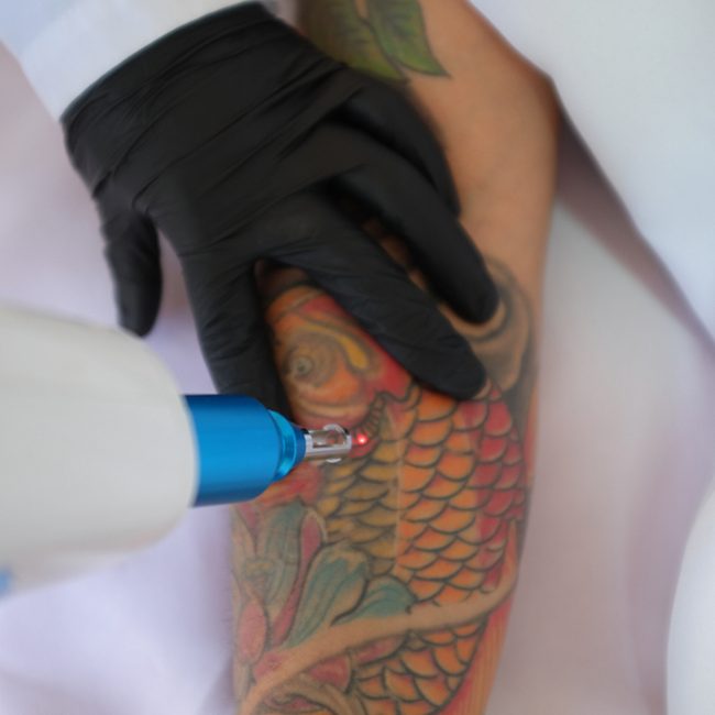 Laser Tattoo Removal Main Image Laser Tattoo Removal Main Image Laser Skin Aesthetics