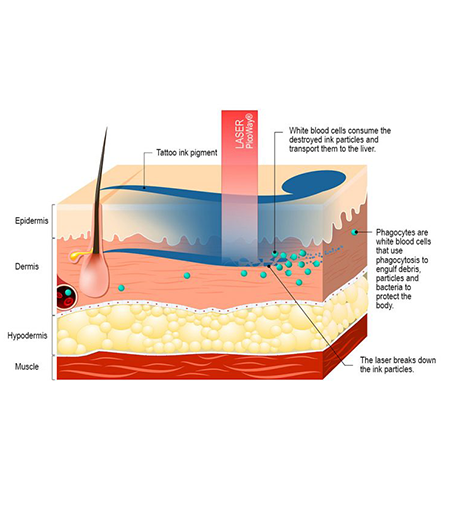 PICOWAY Laser tatto removal PICOWAY Laser tatto removal