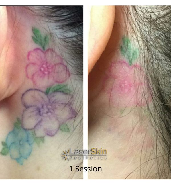 B&A Tattoo Removal FINAL 4 LSA B&A Tattoo Removal FINAL 4 LSA