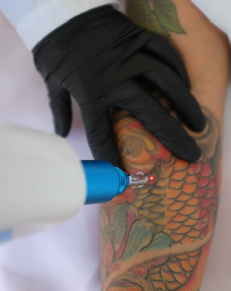 Tattoo Removal Home Page