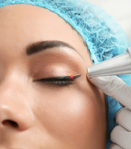 Eyeliner Cosmetic Tattoo Removal