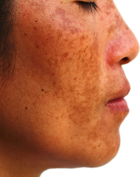 Home Page Image Pigmentation