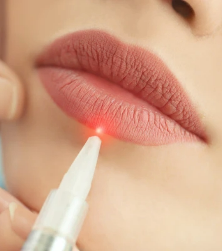 Lip Cosmetic Tattoo Removal Lip Cosmetic Tattoo Removal